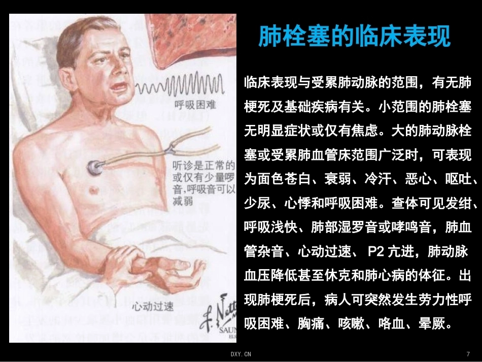关于肺栓塞_第7页
