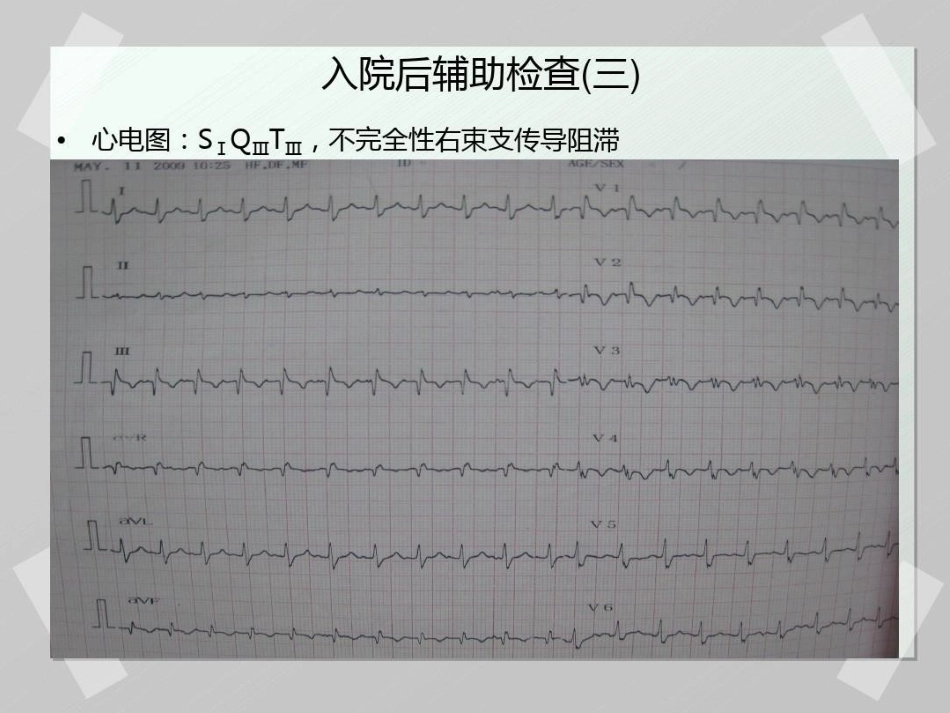 肺栓塞 病例汇报_第10页