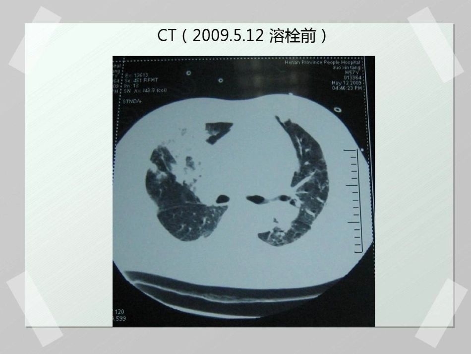 肺栓塞 病例汇报_第15页