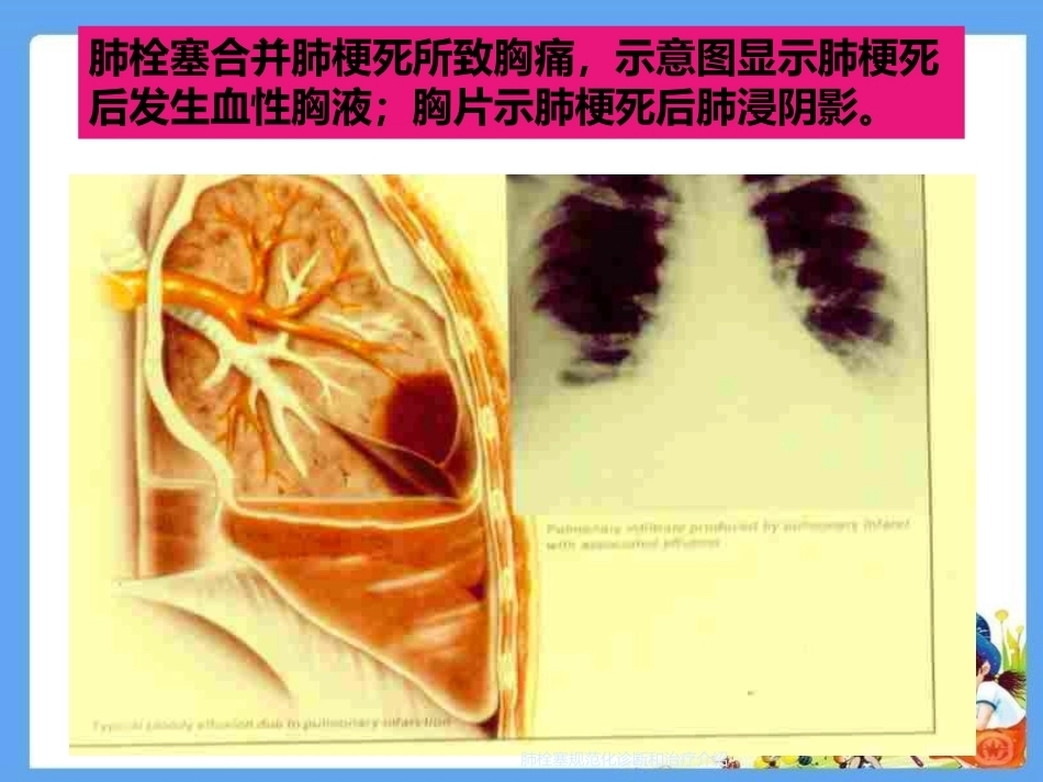肺栓塞规范化诊断和治疗介绍_第11页