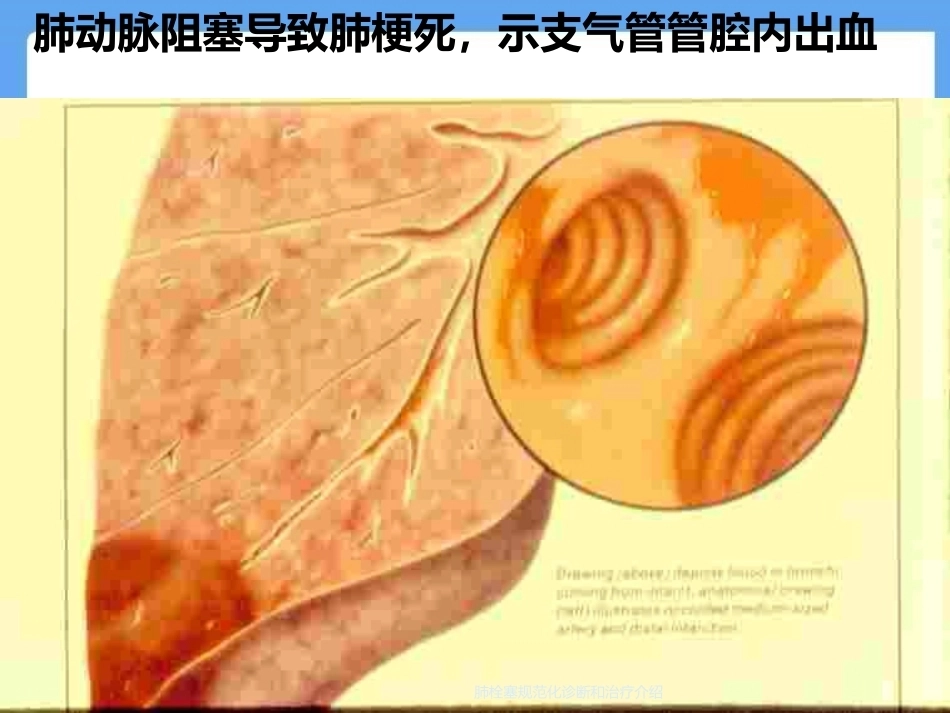 肺栓塞规范化诊断和治疗介绍_第12页