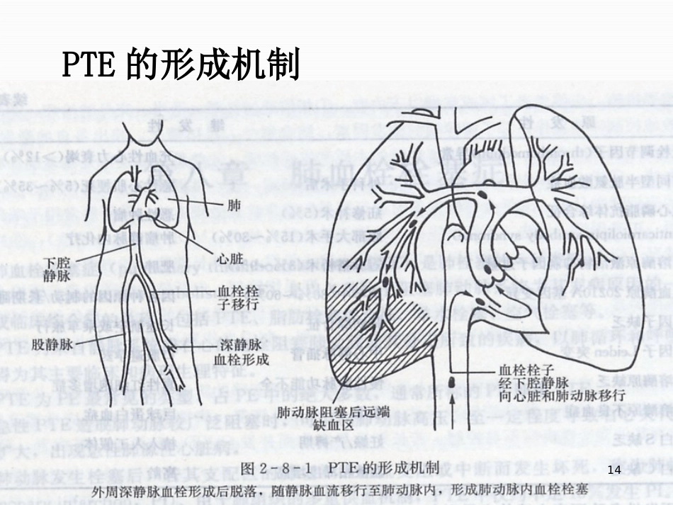 肺栓塞的治疗与护理-_第14页