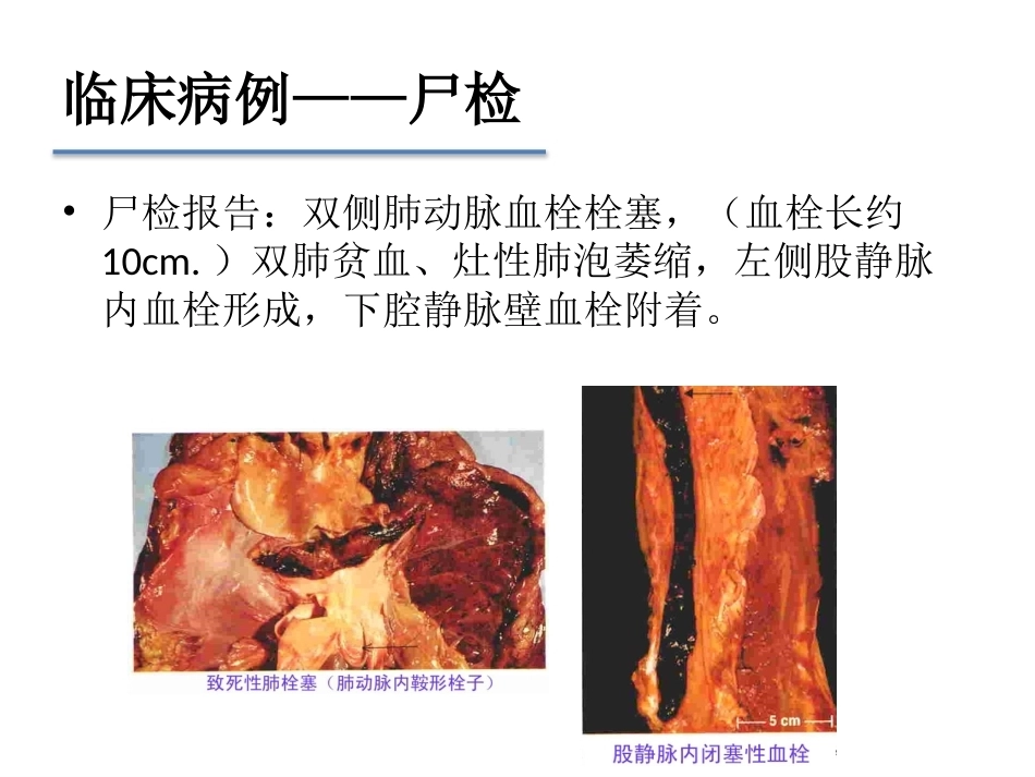 肺栓塞早期发现与诊断(三基三严)_第13页
