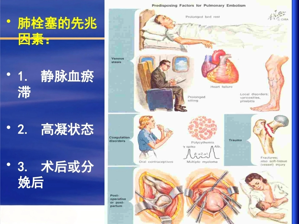 肺栓塞幻灯解读_第12页