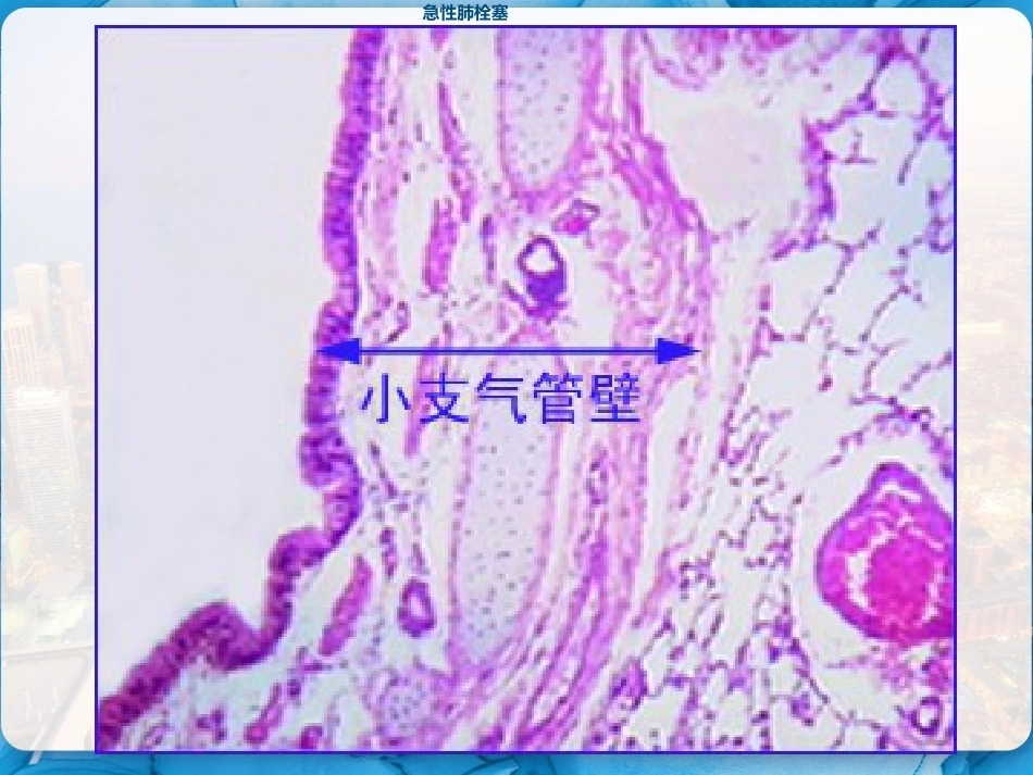 肺栓塞的临床表现和护理措施 PPT_第4页