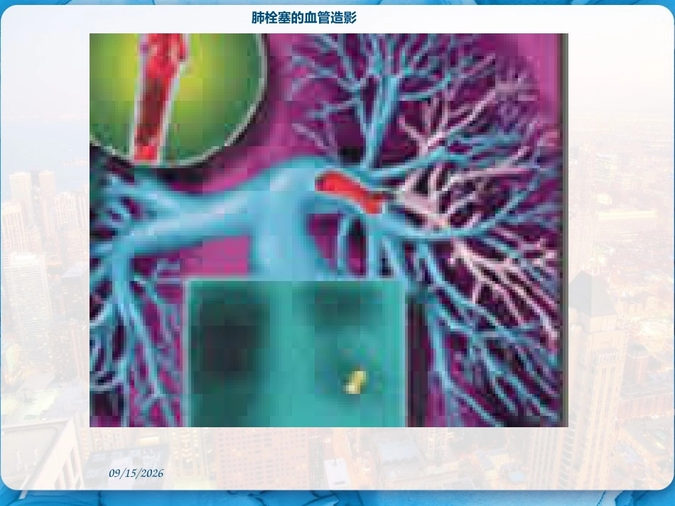 肺栓塞的临床表现和护理措施 PPT_第5页