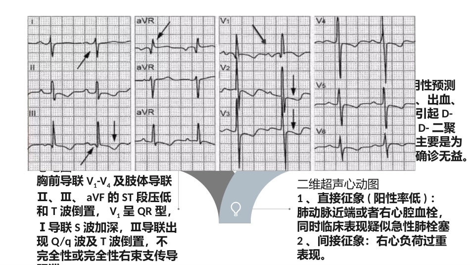 肺栓塞的诊治与护理ppt课件_第10页