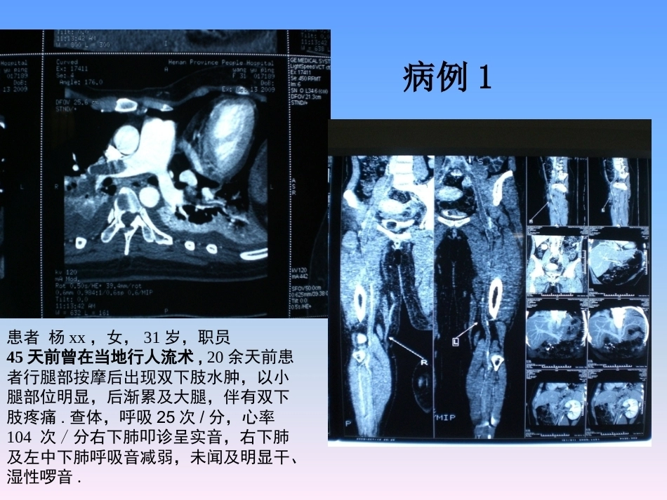 肺栓塞的防治与护理_第1页