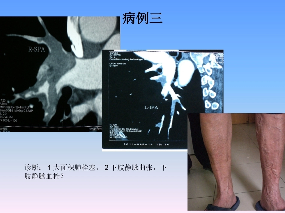 肺栓塞的防治与护理_第10页