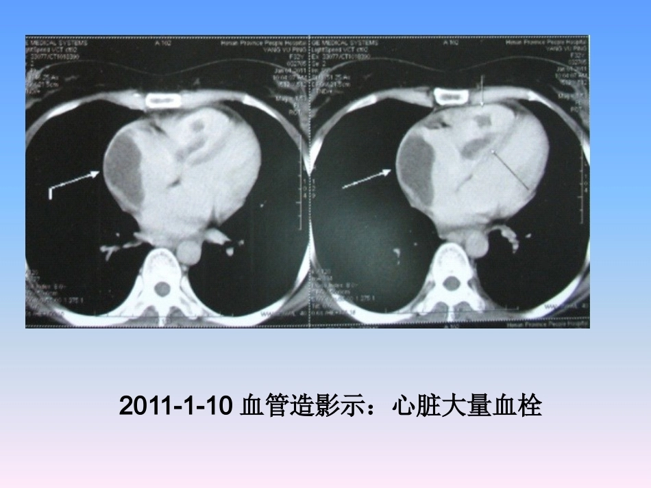 肺栓塞的防治与护理_第6页
