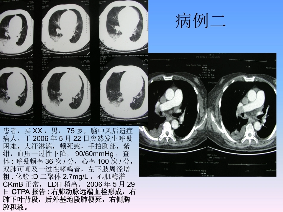 肺栓塞的防治与护理_第7页