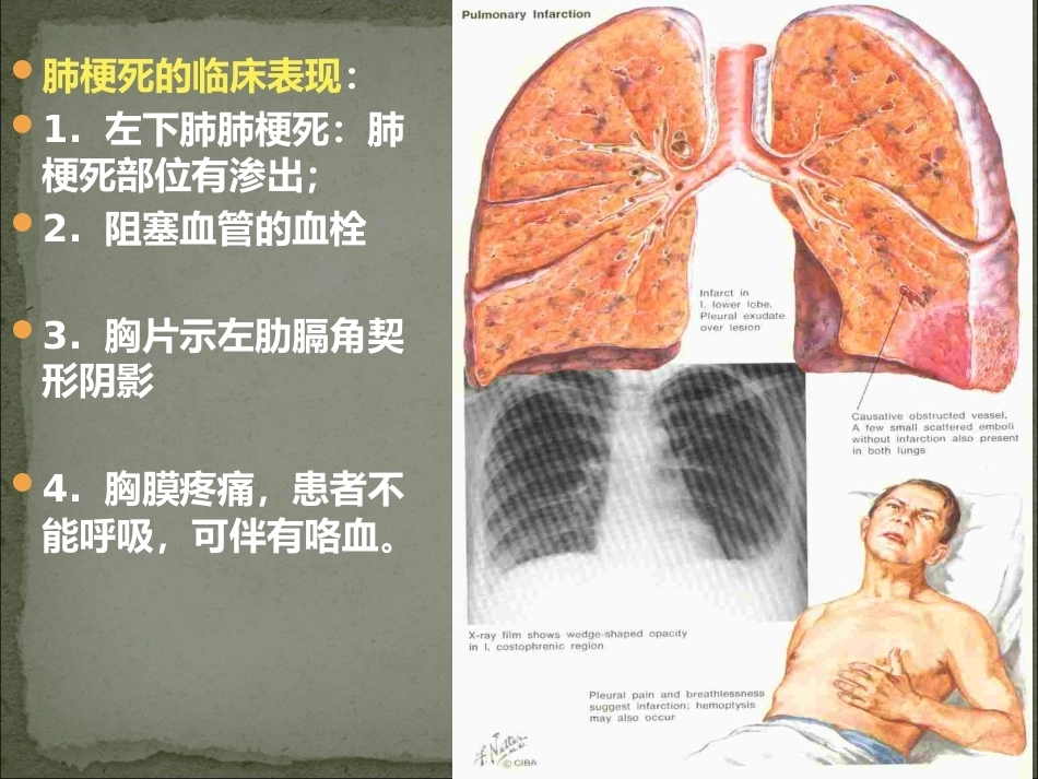 肺栓塞护理_第11页