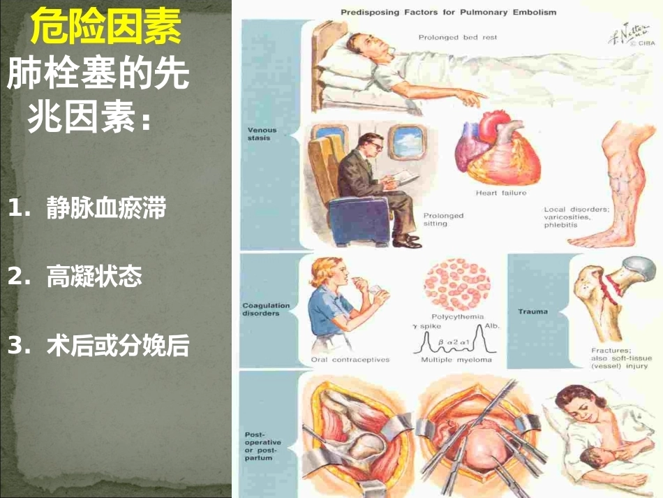 肺栓塞护理_第7页
