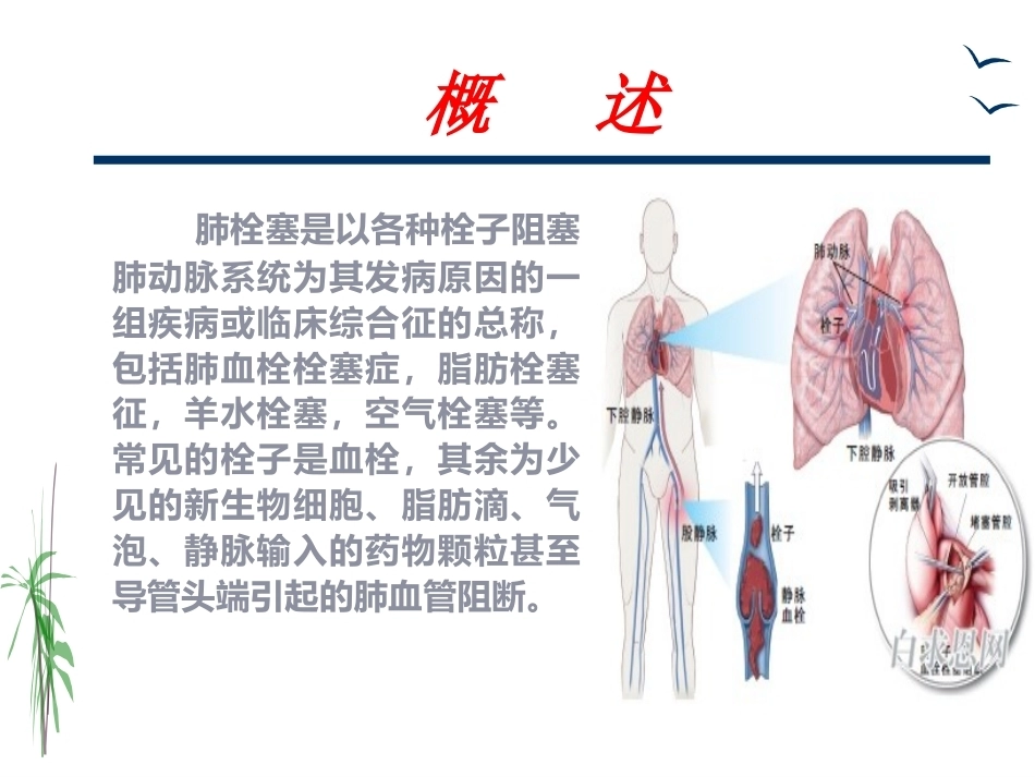 肺栓塞的治疗与护理_第2页
