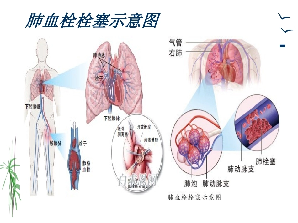 肺栓塞的治疗与护理_第3页