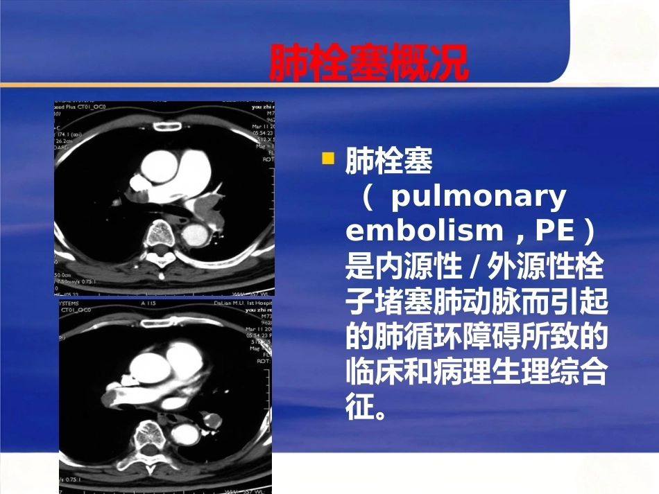 肺栓塞与肺梗死_第3页