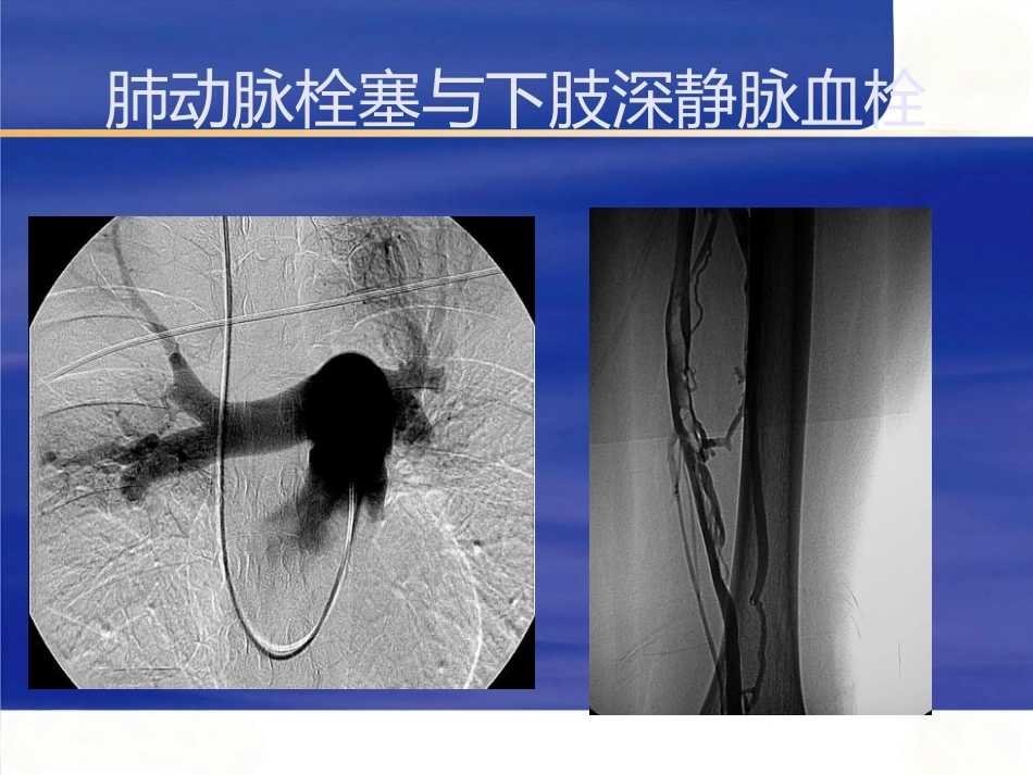 肺栓塞与肺梗死_第6页