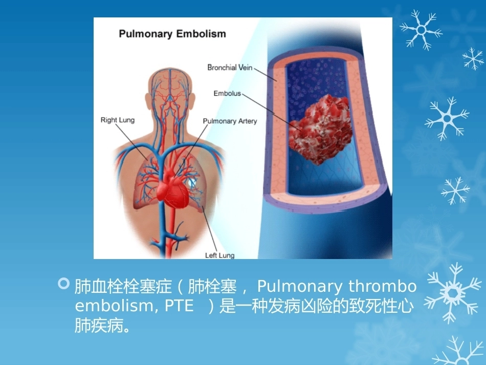 大面积肺栓塞的诊治_第2页