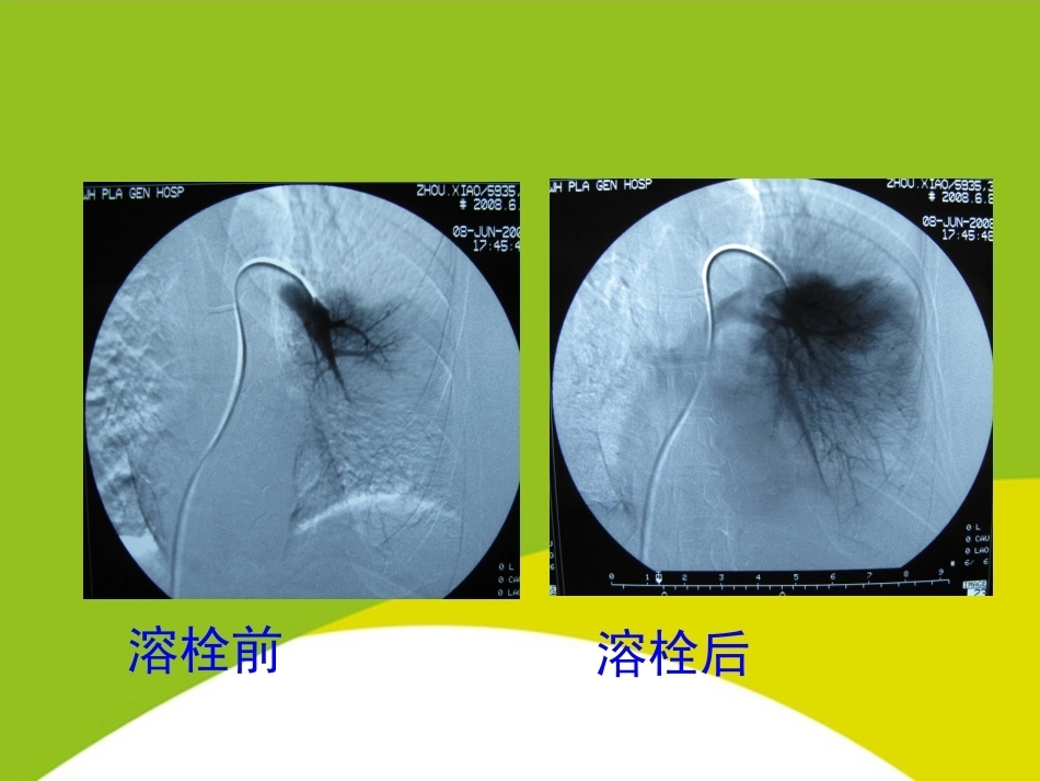 肺栓塞治疗PPT_第4页