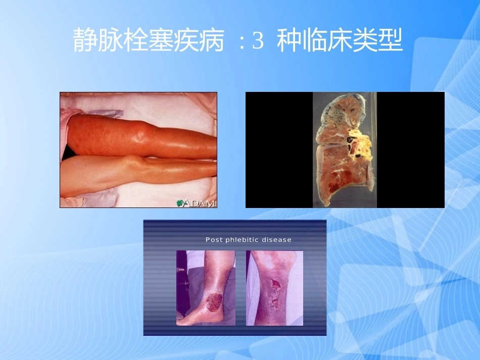 肺栓塞的预防与诊治PPT_第11页