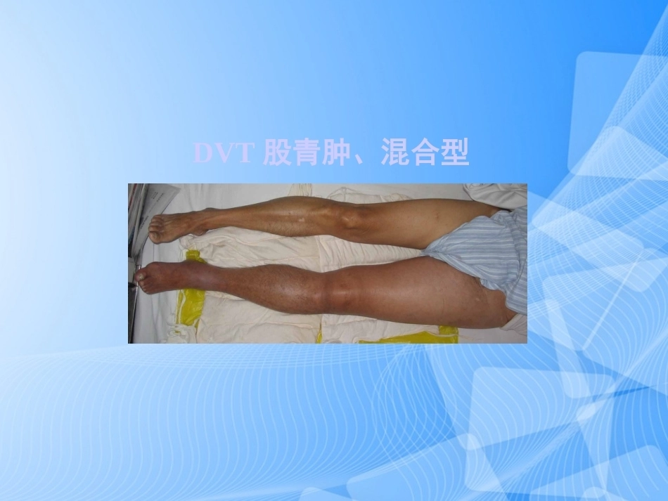 肺栓塞的预防与诊治PPT_第12页