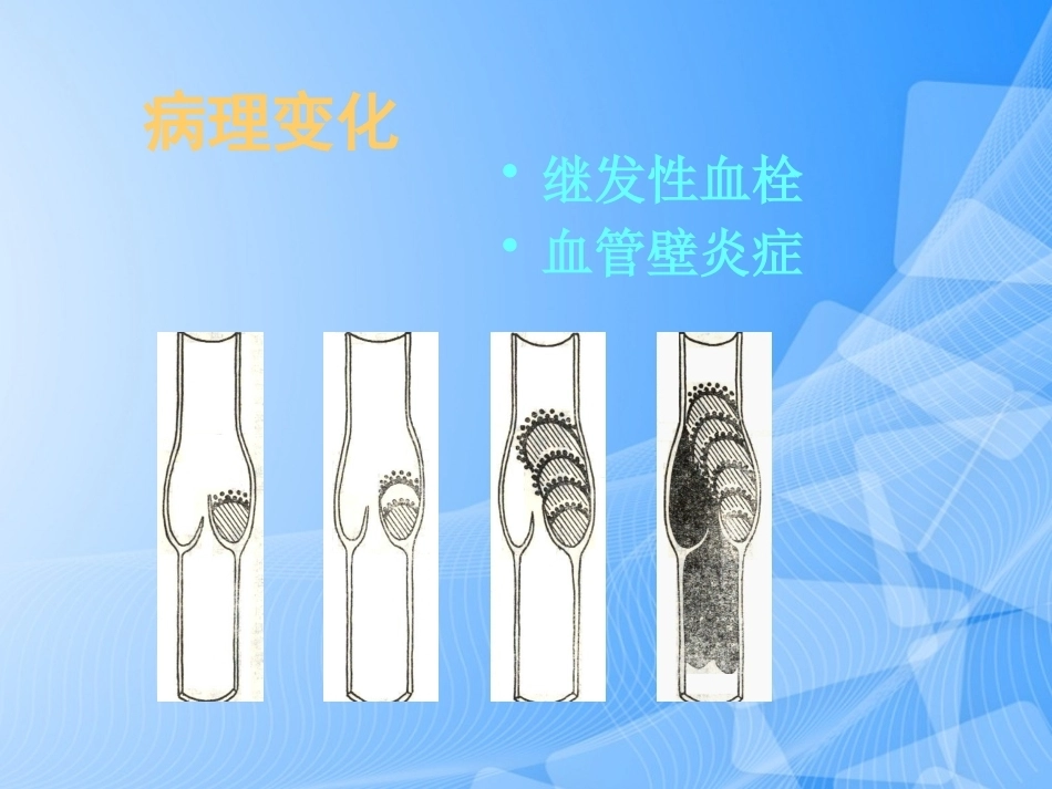 肺栓塞的预防与诊治PPT_第15页