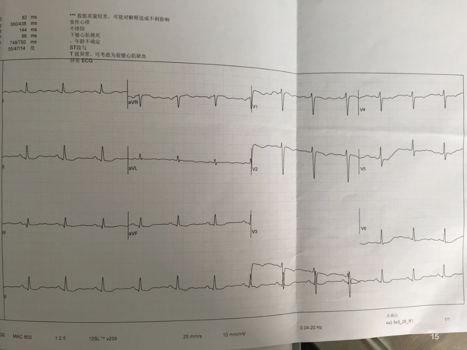 肺栓塞一病例介绍_第15页