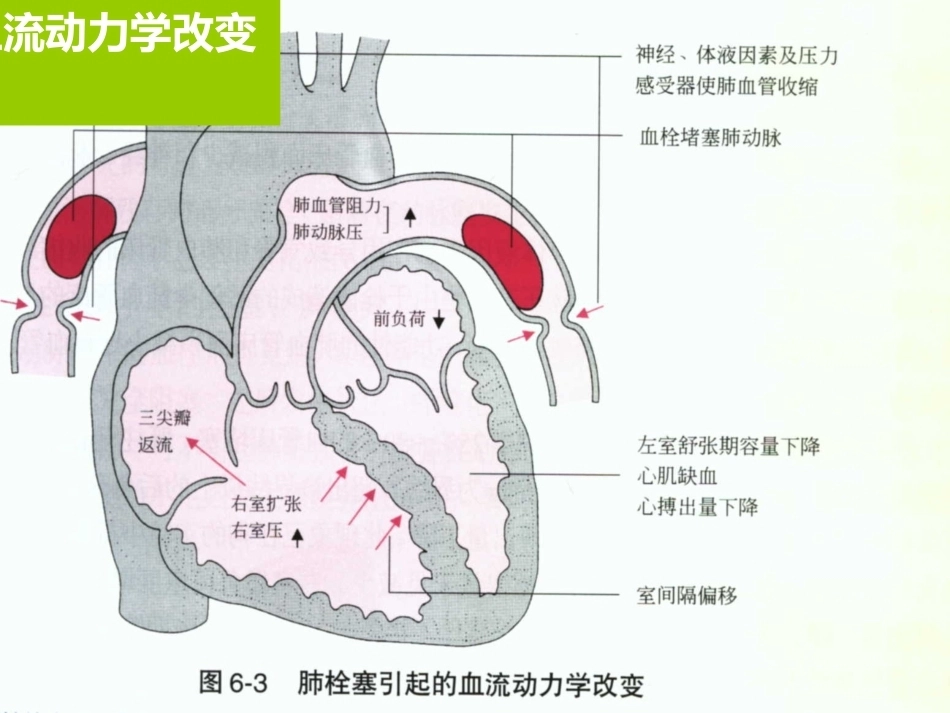 内科学肺栓塞_第13页