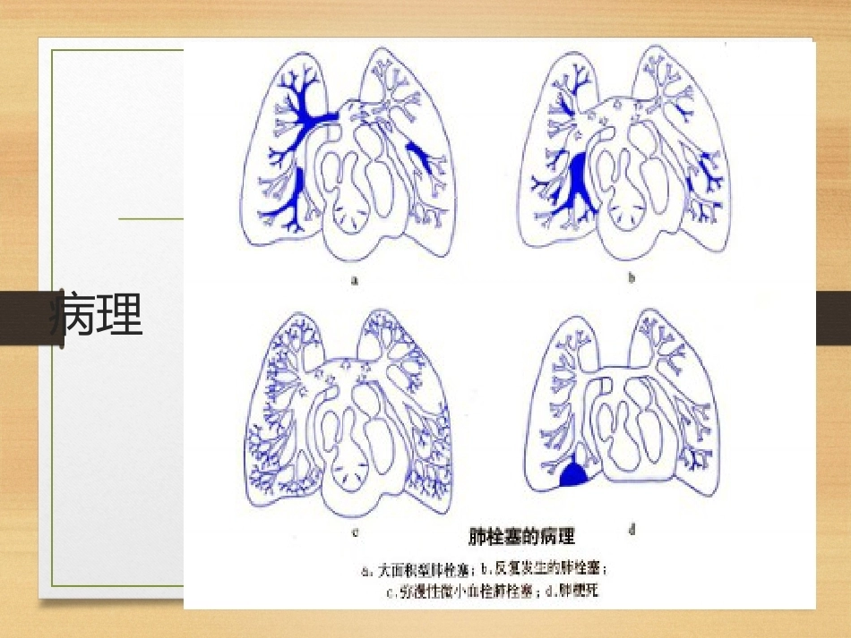 内科学肺栓塞_第14页