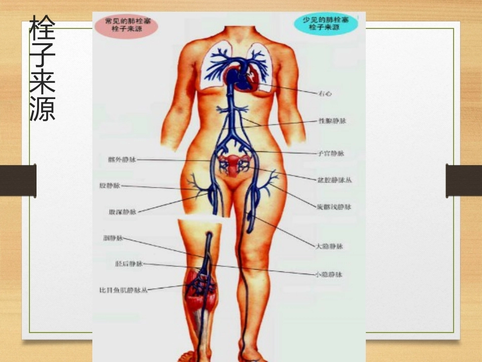 内科学肺栓塞_第5页