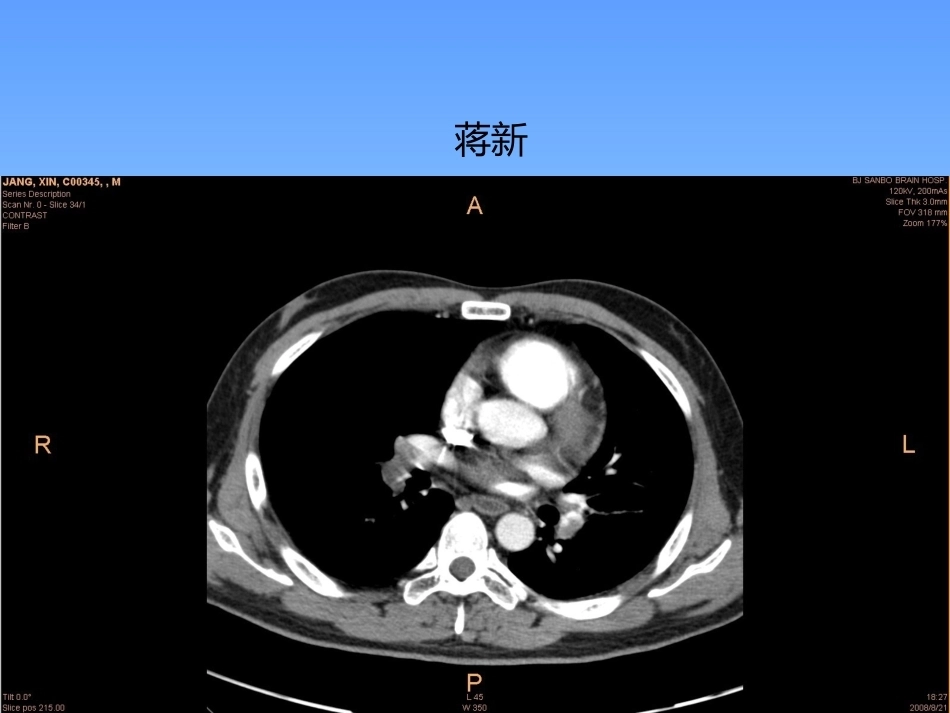肺栓塞病例分享_第15页