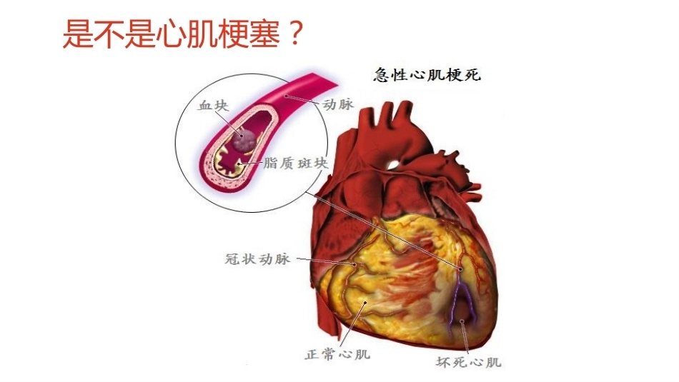 肺栓塞PBL(骨灰版)_第11页