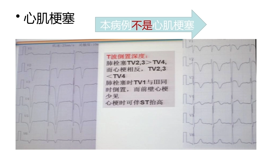 肺栓塞PBL(骨灰版)_第12页