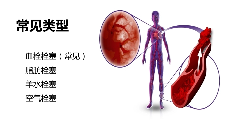 肺栓塞PBL(骨灰版)_第15页