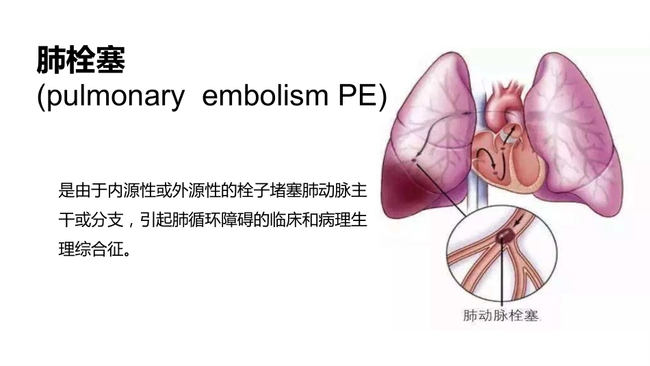 肺栓塞PBL(骨灰版)_第6页