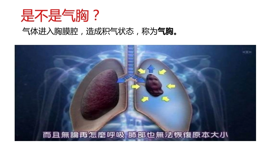 肺栓塞PBL(骨灰版)_第9页