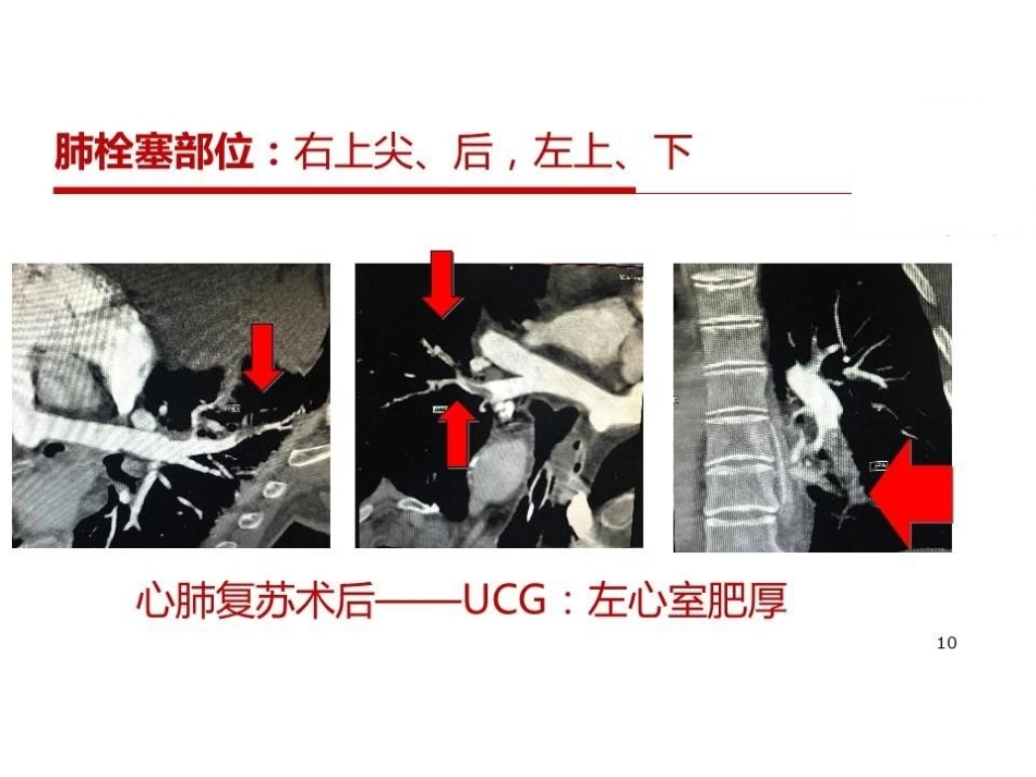 活动性出血与肺栓塞止血还是抗凝？_第10页