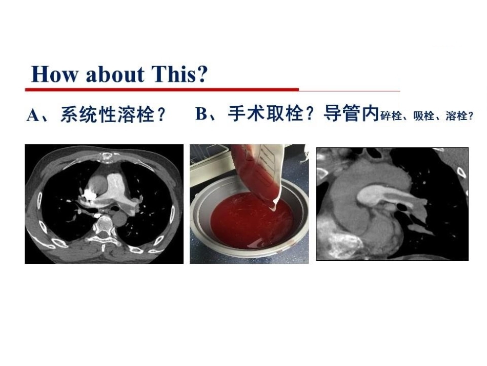 活动性出血与肺栓塞止血还是抗凝？_第9页