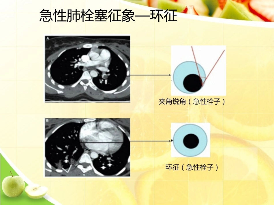 肺栓塞诊断演示_第11页