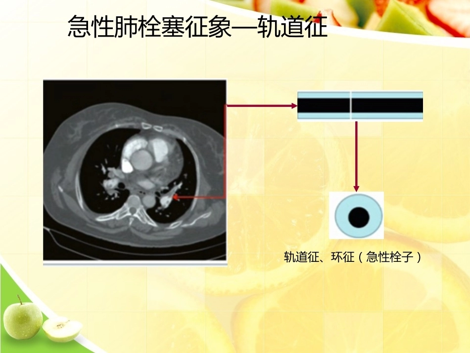 肺栓塞诊断演示_第12页