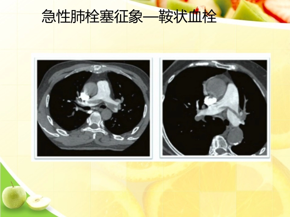 肺栓塞诊断演示_第13页