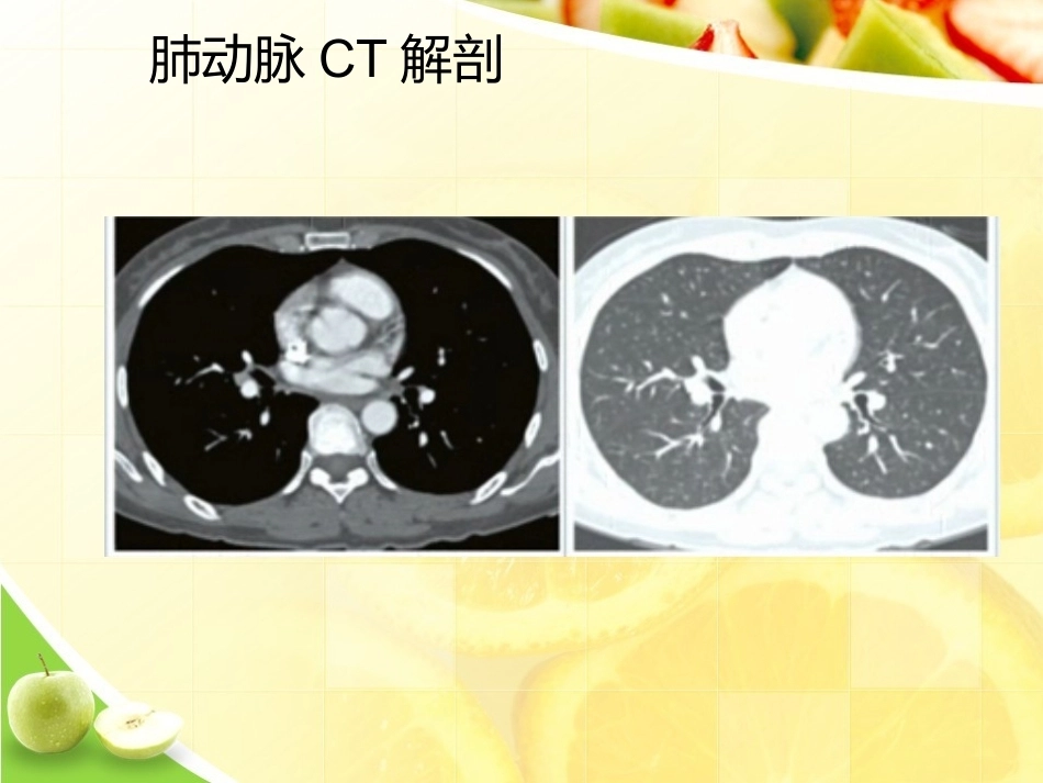 肺栓塞诊断演示_第8页
