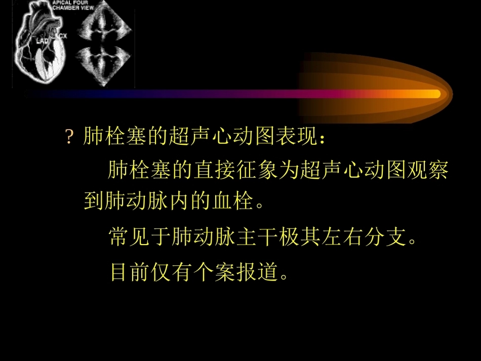 肺栓塞的超声心动图诊断ppt_第2页