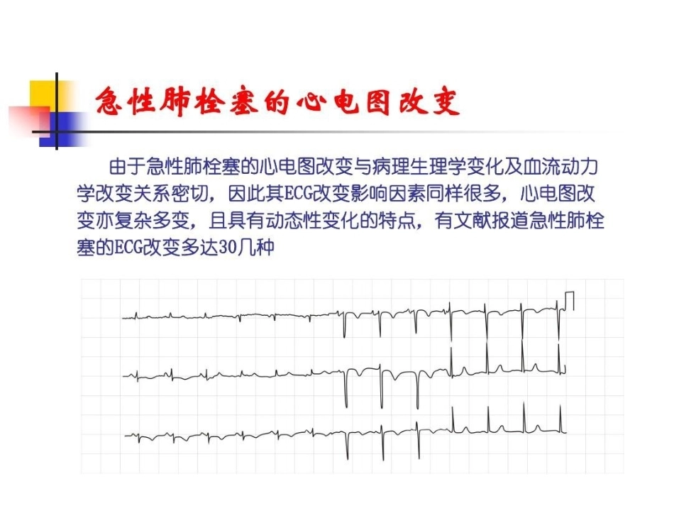 肺栓塞的ECG改变_第10页