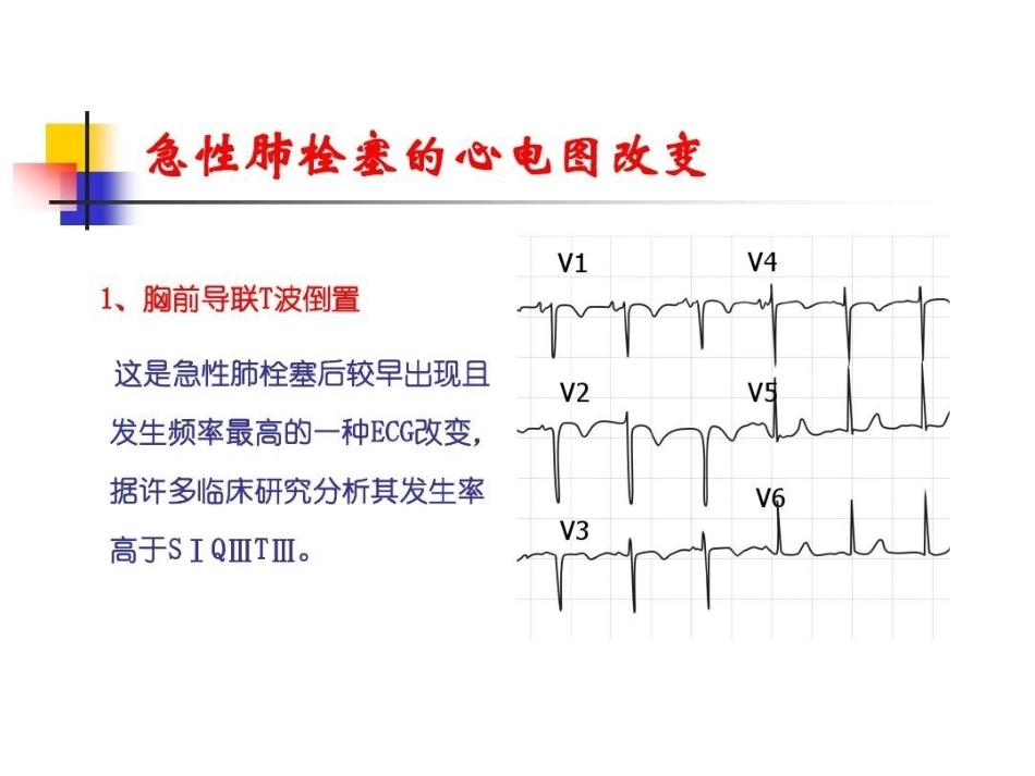 肺栓塞的ECG改变_第11页