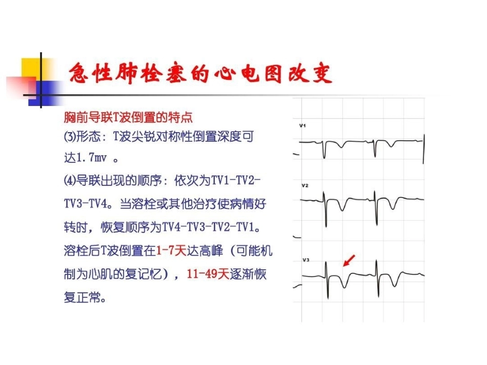 肺栓塞的ECG改变_第13页