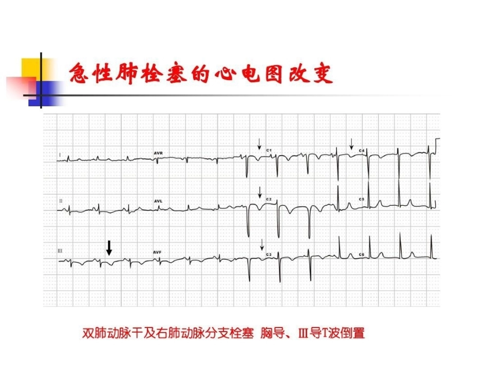 肺栓塞的ECG改变_第15页