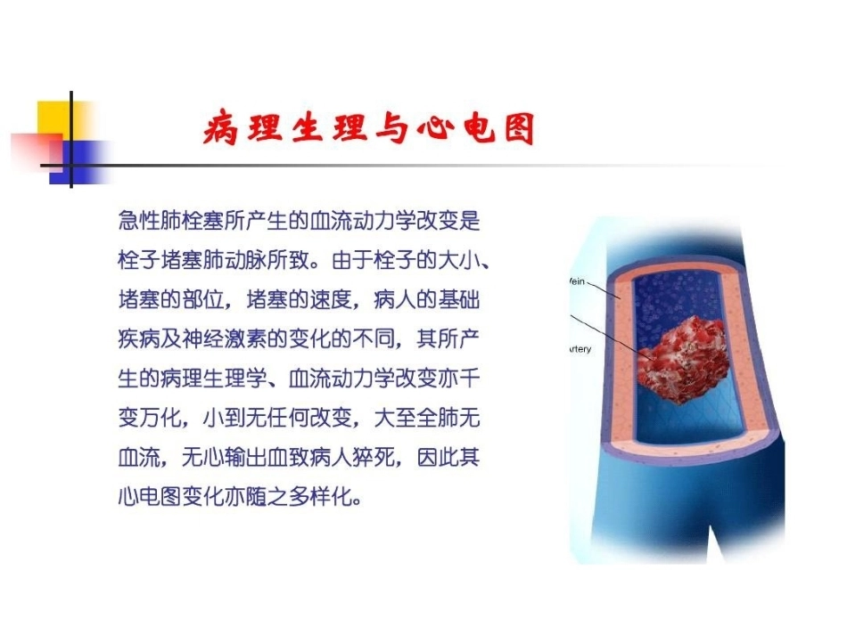 肺栓塞的ECG改变_第7页