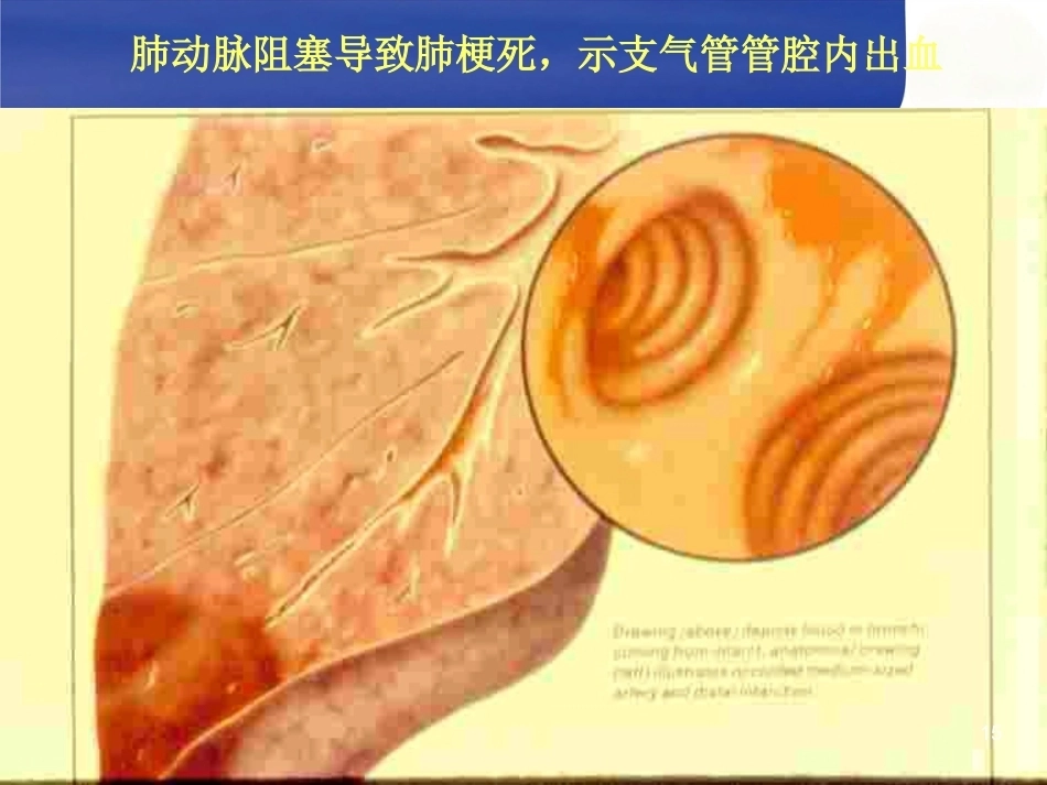 肺栓塞诊断治疗及新进展_第15页