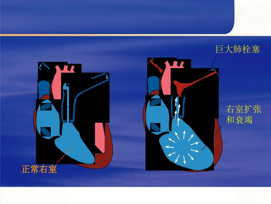 肺栓塞的处理及预防_第9页